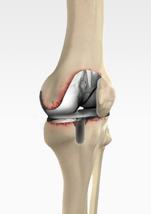 revision-knee-replacement